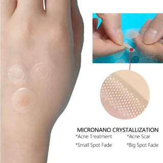 Microneedle Acne Spot Patch – Fast Healing, Scar-Reducing Hydrocolloid Dots